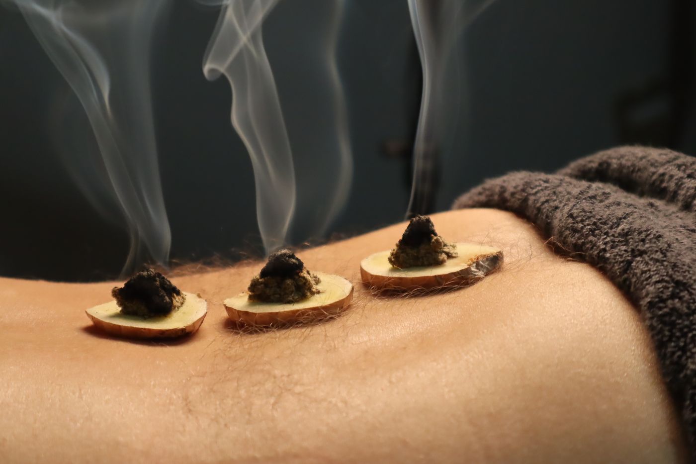 Moxa cones with rising smoke during moxibustion therapy in Dubai